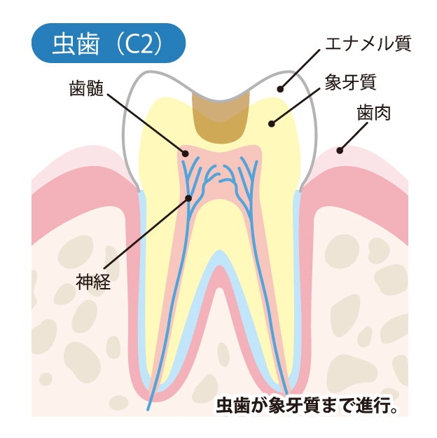 船堀・新小岩（江戸川区）の歯医者、中山歯科医院でむし歯治療