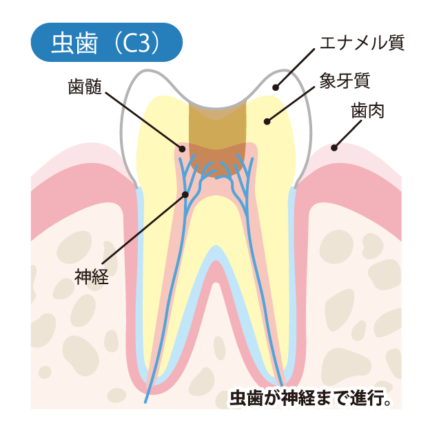 船堀・新小岩（江戸川区）の歯医者、中山歯科医院でむし歯治療