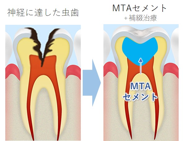 船堀・新小岩（江戸川区）の歯医者、中山歯科医院のMTAセメント