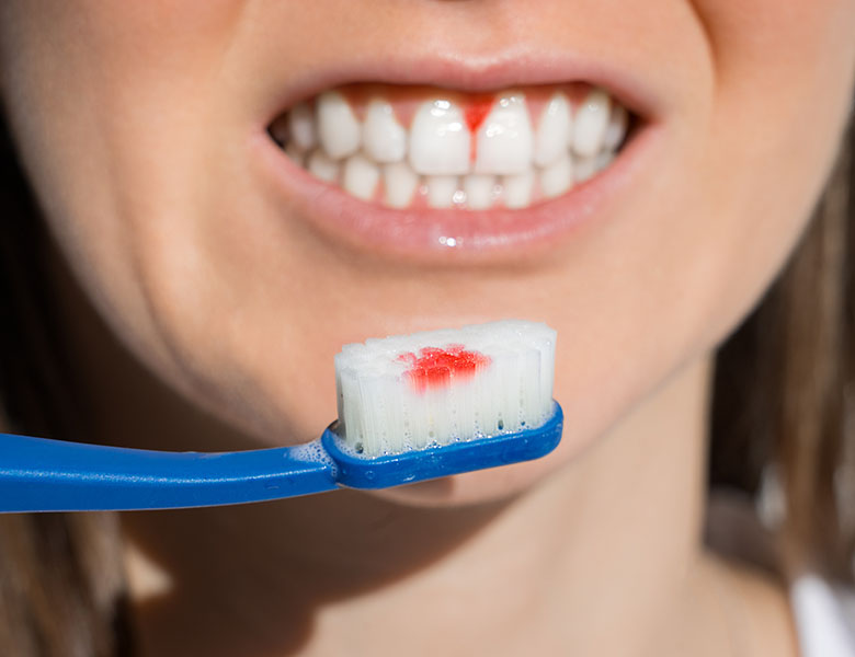 歯周病は自力で治せる？症状改善のためのセルフケア方法を解説