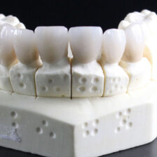 江戸川区•船堀の歯医者、中山歯科医院でセラミック治療後の歯や歯ぐきの痛みについて解説