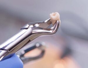 江戸川区•船堀の歯医者、中山歯科医院で歯を抜いたあとの穴はどのくらいでふさがる？期間と注意点を解説