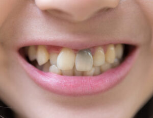 江戸川区•船堀の歯医者、中山歯科医院でホワイトニングについて解説