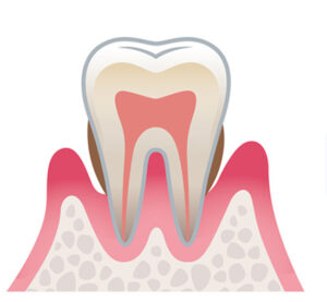 加齢による歯ぐき下がりの原因と進行を遅らせるケア方法を解説