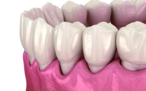 加齢による歯ぐき下がりの原因と進行を遅らせるケア方法を解説