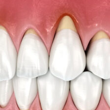 江戸川区•船堀の歯医者、中山歯科医院で加齢による歯ぐき下がりの原因と進行を遅らせるケア方法を解説