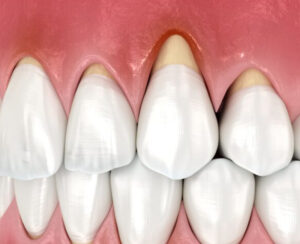 江戸川区•船堀の歯医者、中山歯科医院で加齢による歯ぐき下がりの原因と進行を遅らせるケア方法を解説