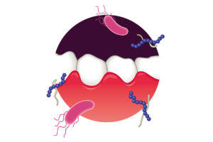 江戸川区•船堀の歯医者、中山歯科医院で入れ歯を外すと歯ぐきが痛む原因を解説