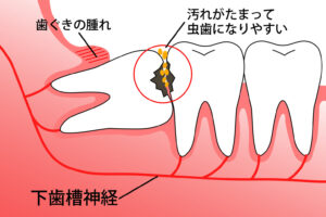 江戸川区•船堀の歯医者、中山歯科医院で、親知らずは抜くべき？抜歯の判断基準とリスクを解説