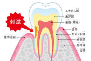 江戸川区•船堀の歯医者、中山歯科医院で、歯のエナメル質が薄い人の特徴とは？遺伝と環境要因の影響を解説